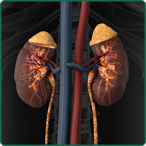 Customized Kidney Solutions with Bharat Homeopathy’s Natural Treatments