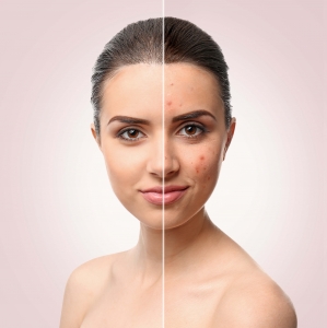 Seasonal Tips for Maintaining Acne-Free Skin in Islamabad