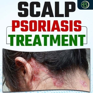 Scalp Psoriasis Treatment: The Best Natural Solutions for Relief
