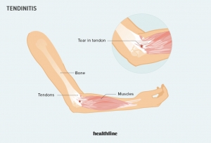 Tendonitis Market Size, Share, Growth, Forecast 2024-34