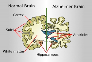 Alzheimer’s Disease Market Share, Industry Trends, Forecast 2024-34