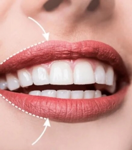 Best Russian Lip Fillers in Dubai – Expert Treatments