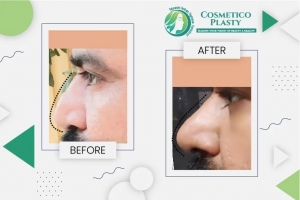 Finding the Best Rhinoplasty Surgeon in Lahore: A Guide to Nose Surgery and Costs