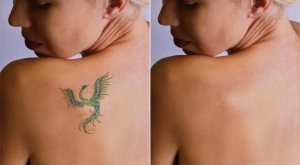 Tattoo Removal Options in Dubai: Why Laser is the Best