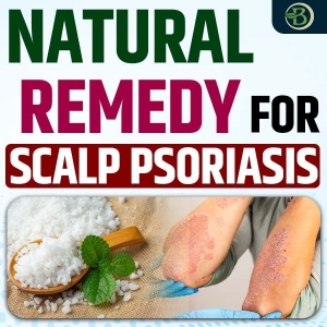 Natural Remedies for Psoriasis: How Homeopathy Soothes Inflamed Skin