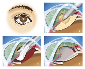 Expert Cataract Surgery in Brisbane – Treatment, Costs & What to Expect