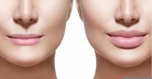 Everything You Need to Know About lip fillers chicago