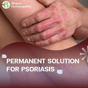 Natural Scalp Psoriasis Treatment: How Effective Is Homeopathy?