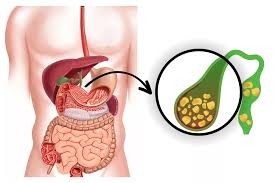 Gallbladder Stone Surgery: The Fast-Track to a Pain-Free Future