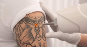 How Long Should You Wait Between Tattoo Removal Sessions?