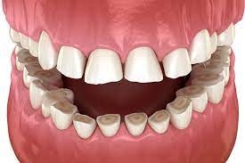 Why Do We Grind Our Teeth, Uncovering the Causes of Bruxism