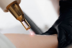 How Does Laser Tattoo Removal Function?