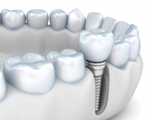 Dental Implant Maintenance, What You Need to Know