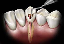 Everything You Need to Know About Posterior Root Canals