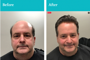 Instant Hair Restoration Without Surgery