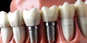 Preventing Bone Loss Due to Dental Implant Infection