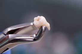 The Role of Dental Extractions in Preventing Oral Complications