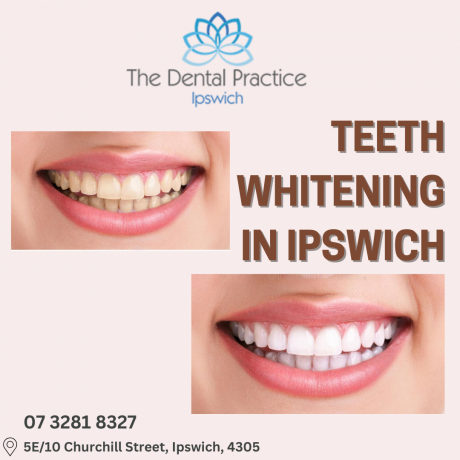  in Ipswich Teeth Whitening