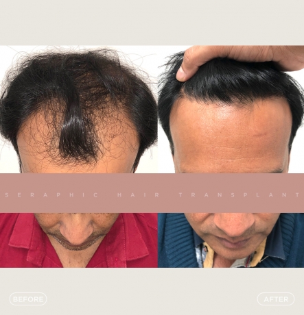 indore hairtransplant