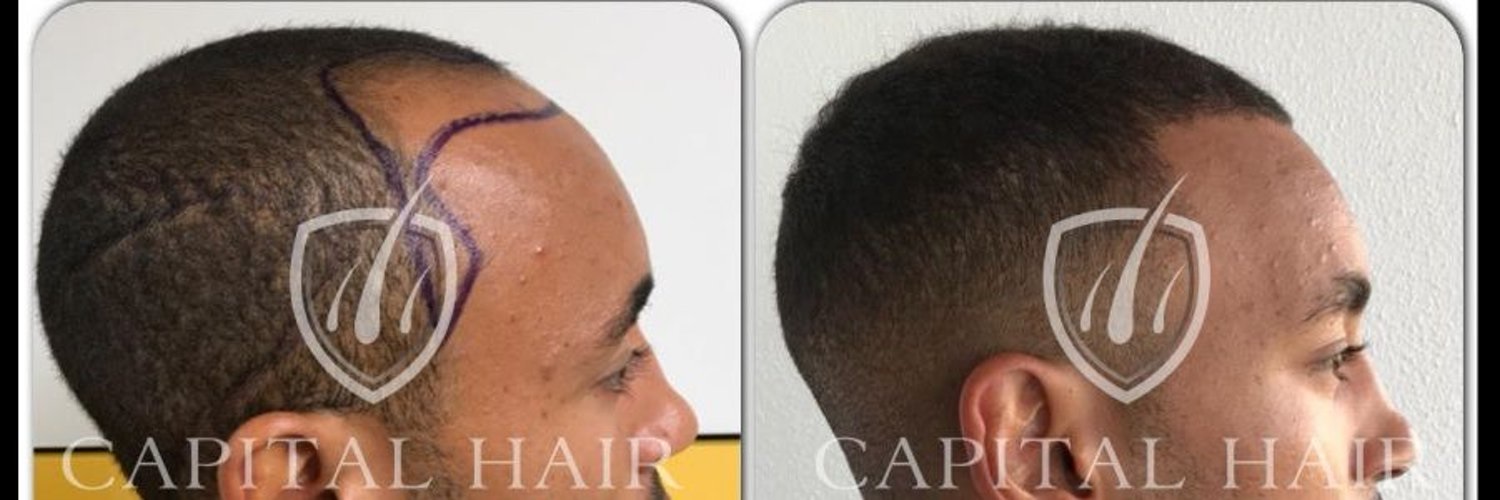 uk hairrestoration