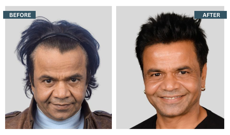 In India Hair Transplant Clinic