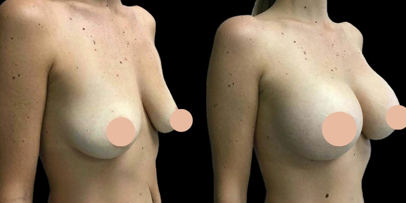 Augmentation Breast