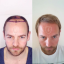 capital hairrestoration