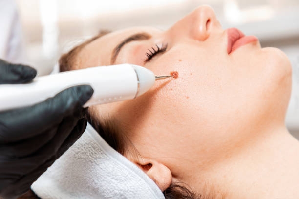 Laser Mole Removal Unveiled: A Comprehensive Guide