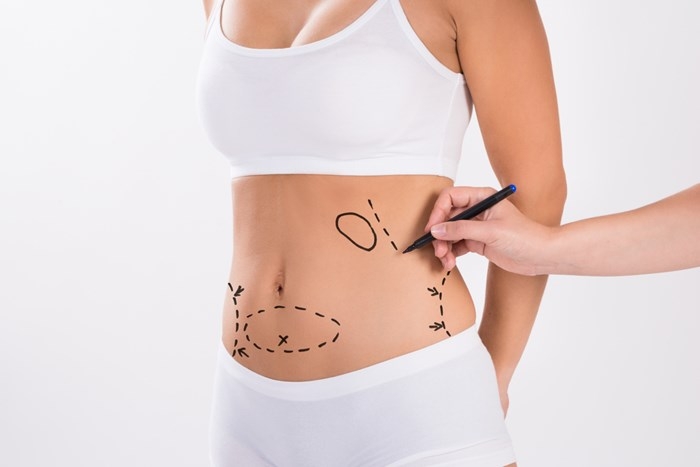 Post-Liposuction Care: A Comprehensive Guide