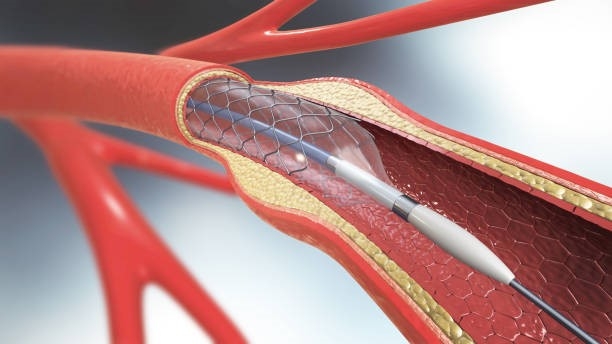 The Future of Cardiovascular Health: Vascular Surgery Insights