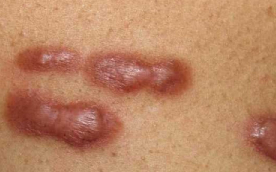 Smooth Skin Awaits: Keloid Removal Options in Dubai