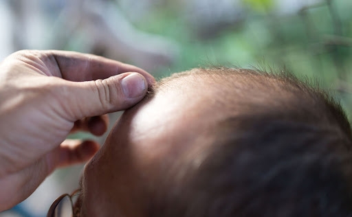Transform Your Tresses: Hair Loss Treatments in Dubai