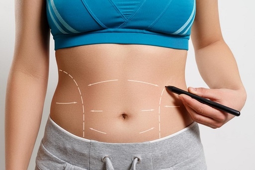 Achieving Your Dream Figure with a Hassle-Free Tummy Tuck