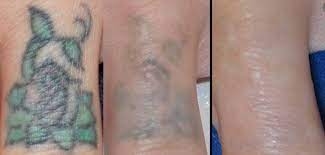 Exploring The Step-By-Step Process of Laser Tattoo Removal