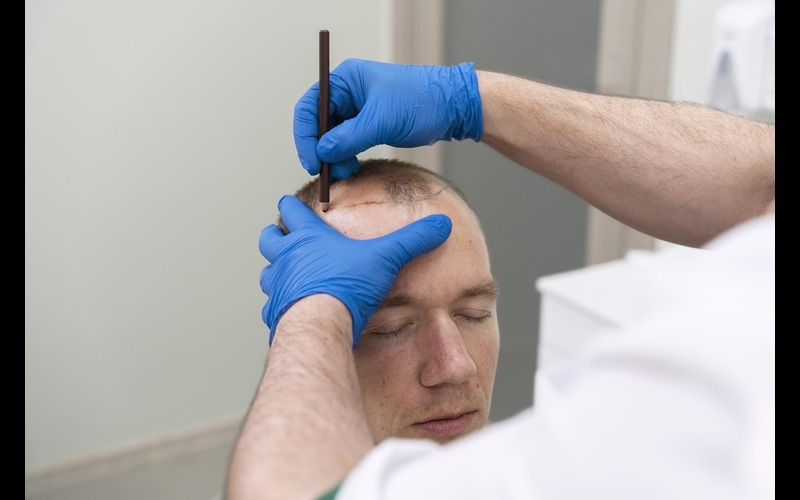 Revitalize Your Locks: Exploring PRP Hair Treatment in Riyadh