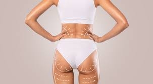 Unveiling the Perfection: Brazilian Butt Lift (BBL) in Dubai