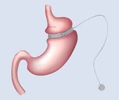 Maximizing Success with Gastric Band Surgery in Dubai