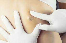 Comprehensive Guide to Lipoma Treatment in Dubai