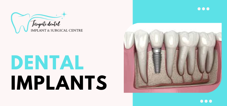 The Advantages of Dental Implants
