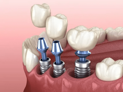 Evolution of Dental Implants Leichhardt: What to Expect 