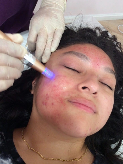 Revitalization or Risk? Examining the Vampire Facial