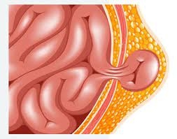 Minimally Invasive Hernia Surgery in Dubai