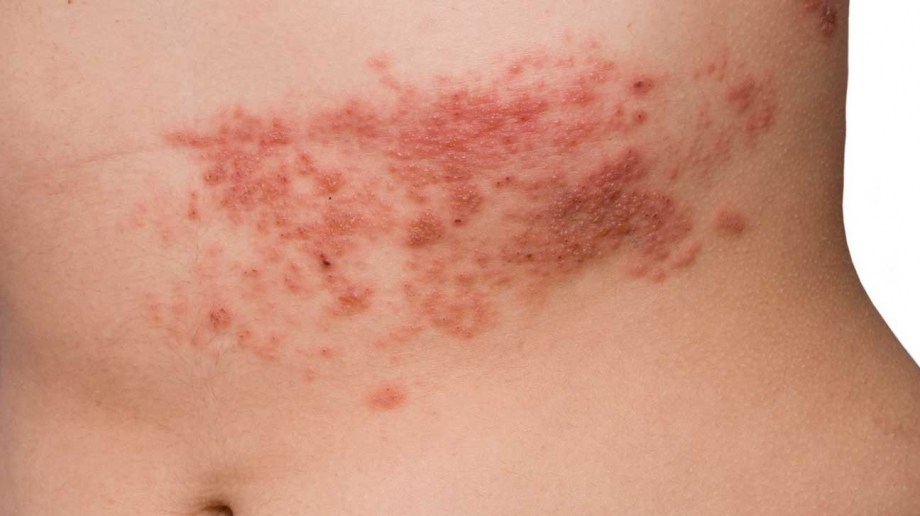 Unveiling the Mystery: Skin Rash Causes in Dubai