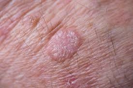 Preventing Actinic Keratosis on Your Hands