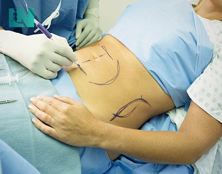 Liposuction Consultation: Dubai Experts’ Tips