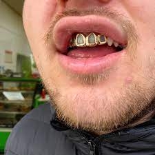 Golden Grins: Explore Dubai's Gold Fang Grillz Collection