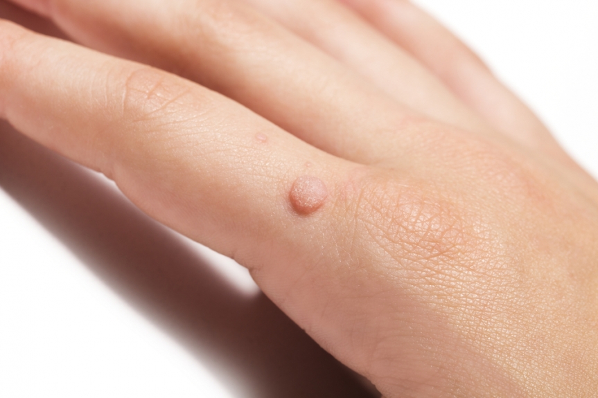 Subzero Solutions: Cryotherapy for Stubborn Warts