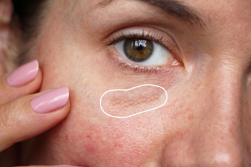 Say Goodbye to Milia: Top-Rated Milia Treatments in Dubai  pen_spark