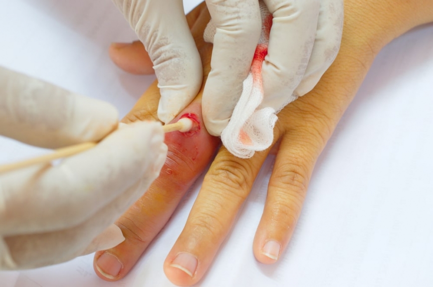 Minimally Invasive Abscess Drainage Options in Dubai