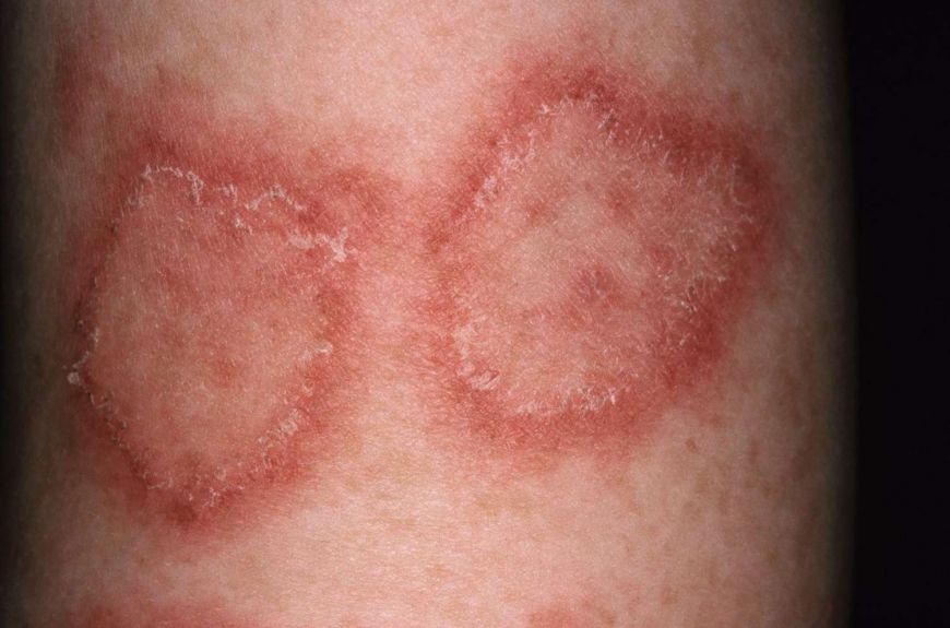 Affordable Skin Disease Treatment Packages in Dubai